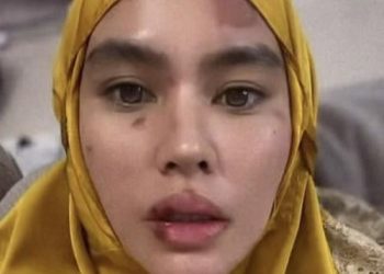 Kartika Putri Idap Penyakit Autoimun