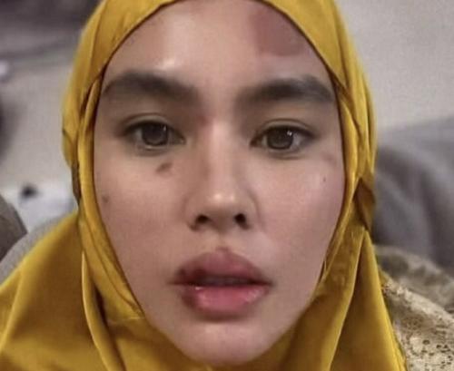 Kartika Putri Idap Penyakit Autoimun 1 Kartika Putri Idap Penyakit Autoimun