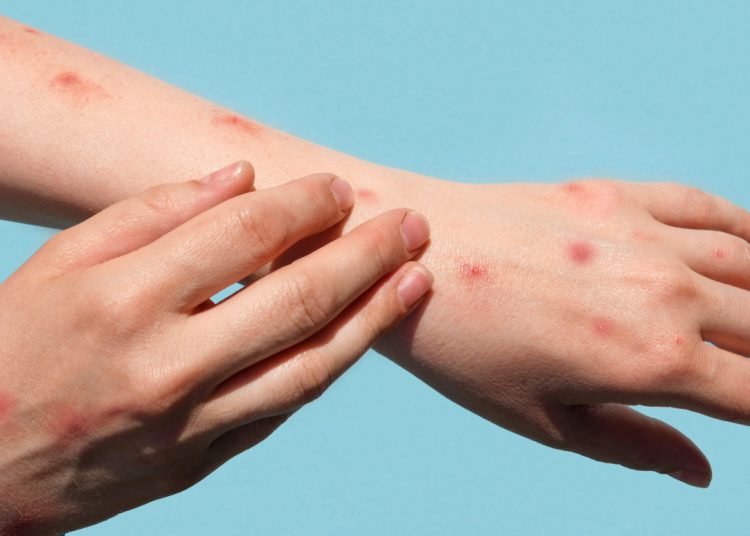 Jawa Tengah Masih Bebas Kasus Monkeypox (Cacar Monyet) Warga Diminta Tetap Waspada